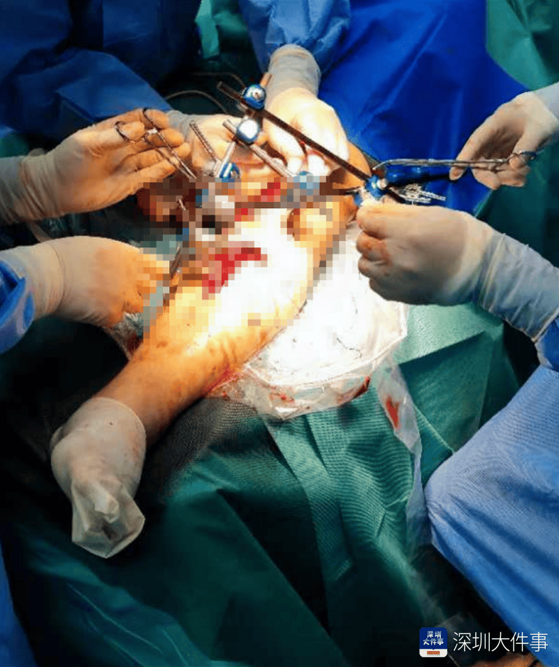 失血过半！深圳男子被三四百斤模具砸到<strong></p>
<p>松原虚拟币</strong>，医生全力抢救