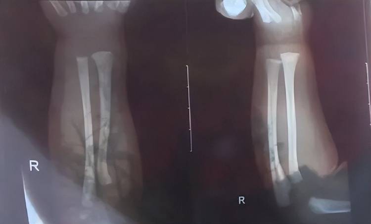 广西一男婴在月子中心被照料20天：身上2处骨折<strong></p>
<p>水果虚拟币</strong>，育婴室监控无法查看