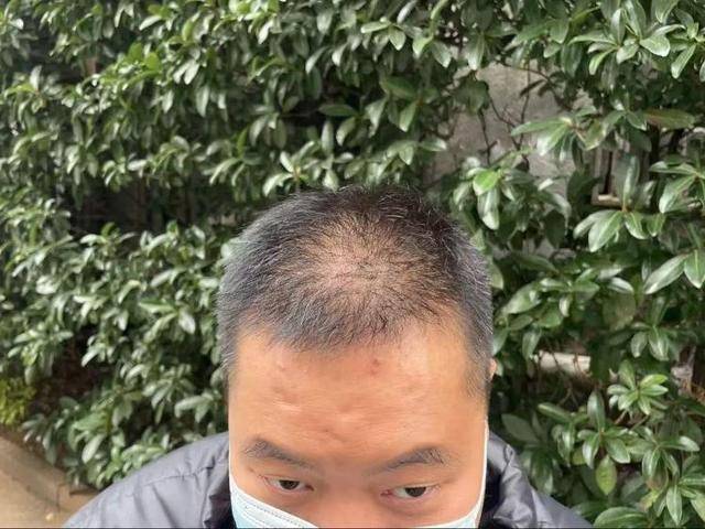 “还能反光<strong></p>
<p>雅视虚拟币</strong>！”长沙男子植发近9月称后脑勺“像狗啃过”