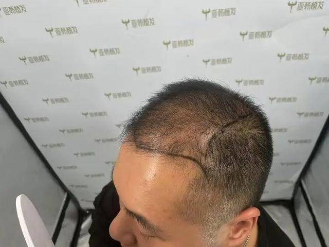 “还能反光<strong></p>
<p>雅视虚拟币</strong>！”长沙男子植发近9月称后脑勺“像狗啃过”