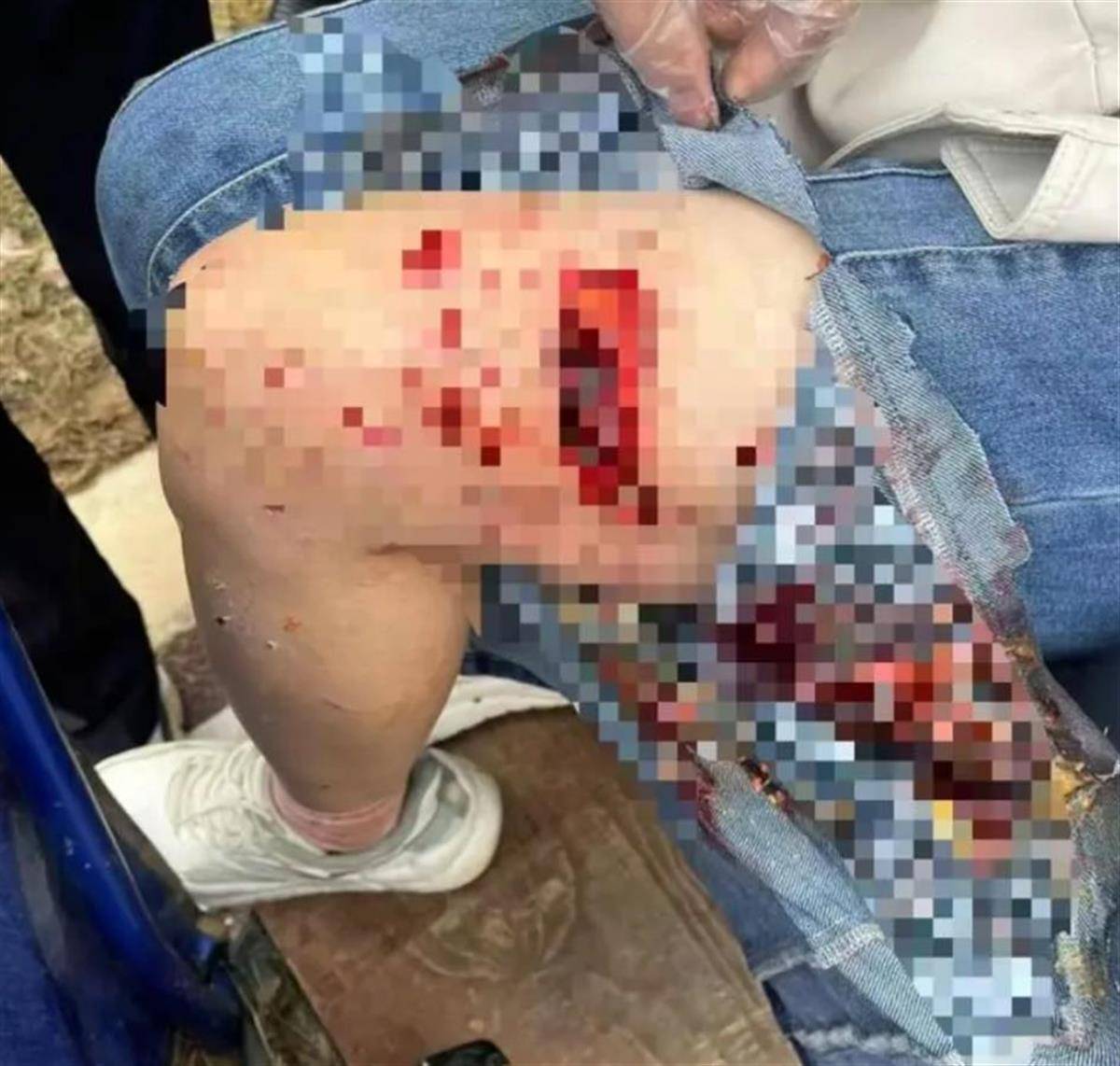 母女散步遭4条大型犬撕咬:狗主人系当地一工程老板 已被采取强制措施