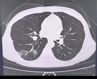 查出流感没在意<strong></p>
<p>虚拟币</strong>，女子硬扛三天后肺都“白”了……