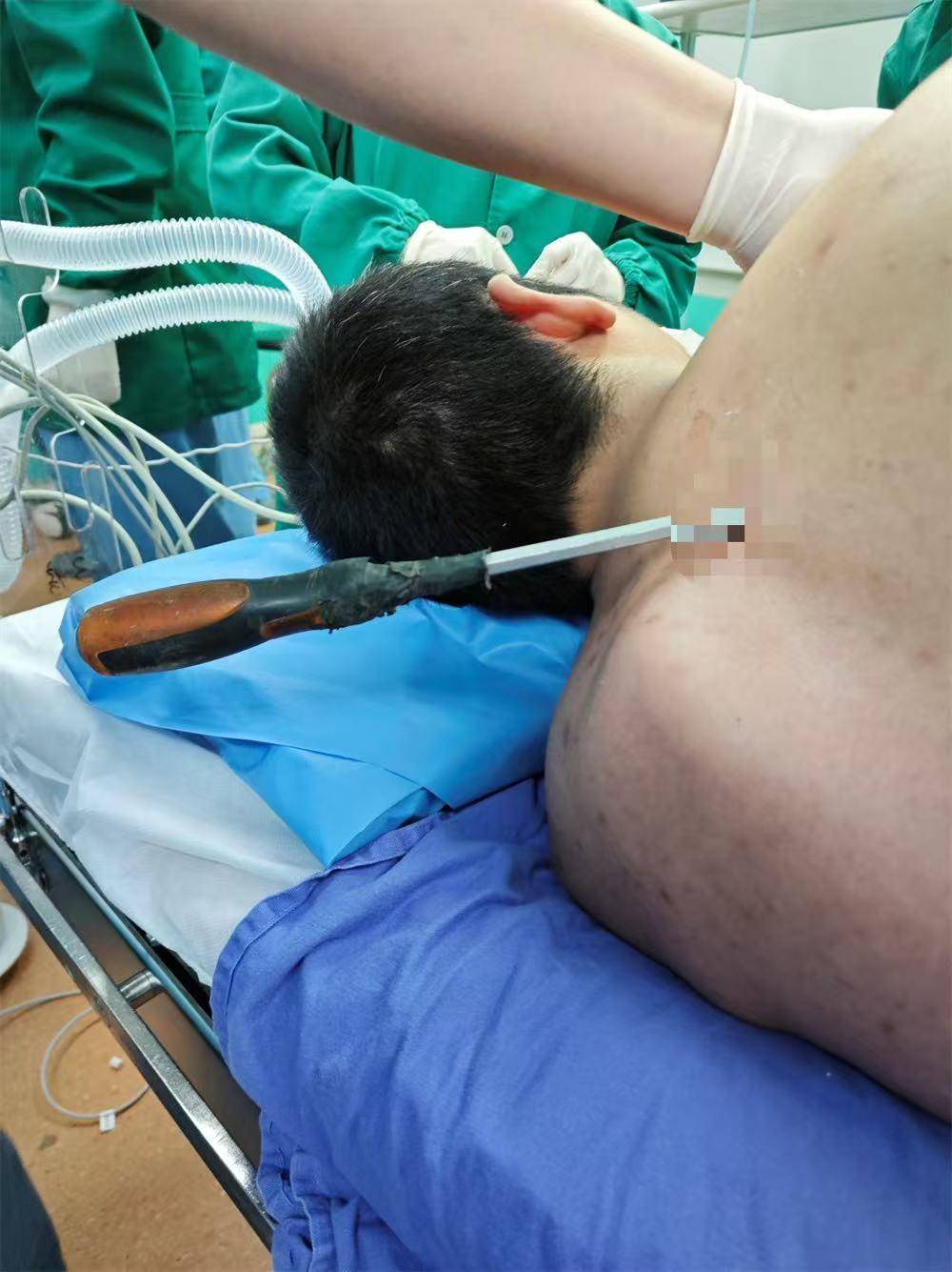 20米高空掉落螺丝刀直插男子胸腔<strong></p>
<p>区块链虚拟币</strong>！医生：不要自行拔除