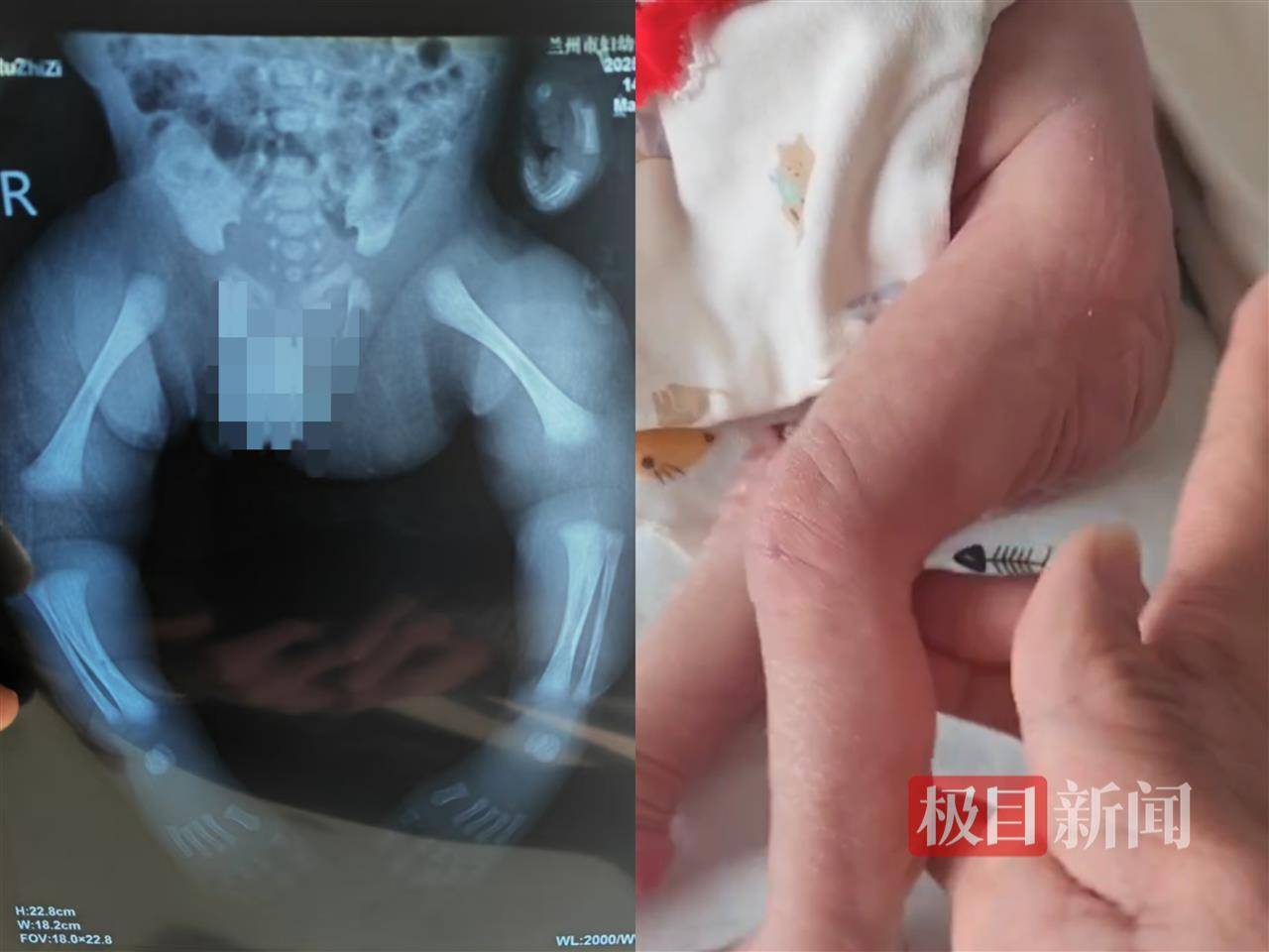 二胎出生查出先天性病症或落下残疾<strong></p>
<p>虚拟货币世界币</strong>,残疾父母称医院产检漏检、未尽告知义务,医院及医调委回应