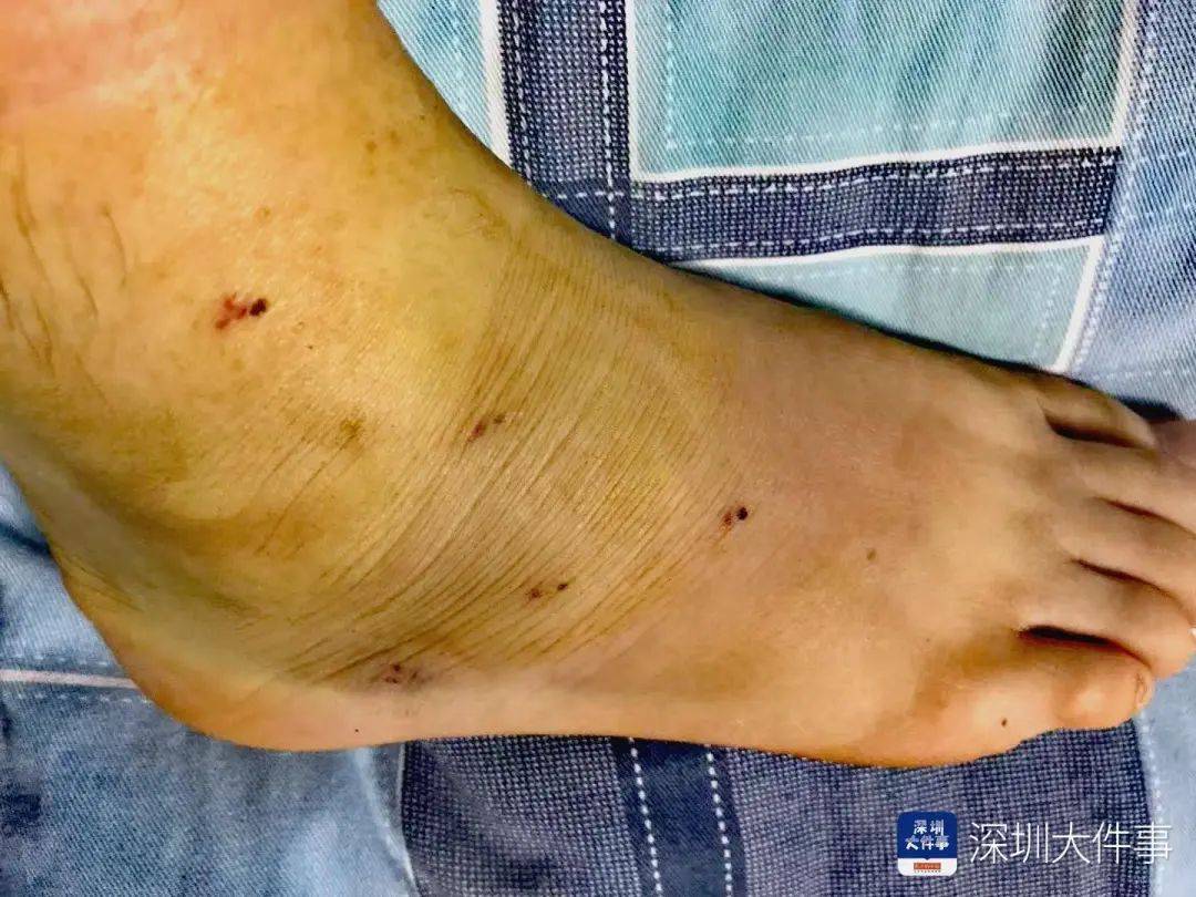 “一走路就痛”！女子脚踝受伤遭漏诊<strong></p>
<p>虚拟币LOL</strong>，治了7年没好！深圳一医院被告上法庭