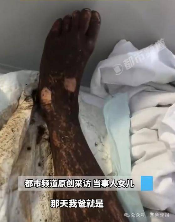 安徽宣城一男子走路玩手机<strong></p>
<p>上海莱士股票</strong>,一脚踩中打架的竹叶青和五步蛇,被俩毒蛇咬3口!医院:暂无生命危险,正在治疗