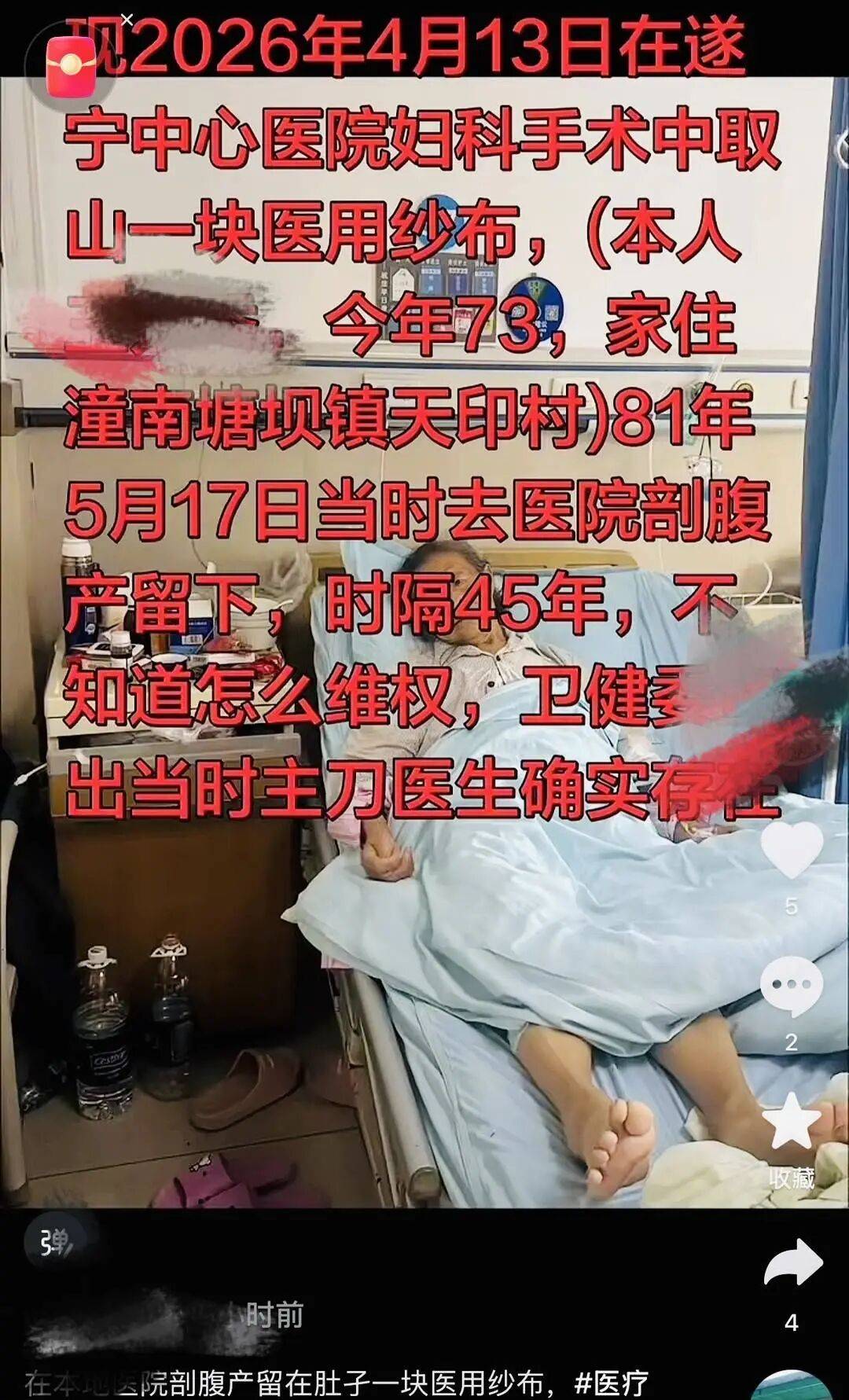 45年前纱布遗留体内？73岁老人体内取出“纱布样”腐朽异物，涉事医院已启动调查核实